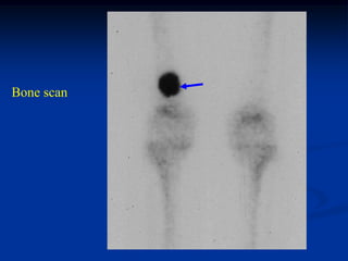 Bone scan
 