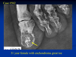 Case #562




     31 year female with enchondroma great toe
 