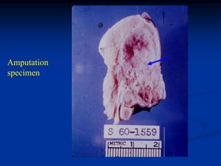 Amputation
specimen
 