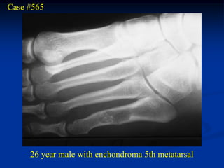 Case #565




     26 year male with enchondroma 5th metatarsal
 