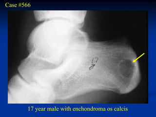 Case #566




       17 year male with enchondroma os calcis
 