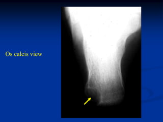 Os calcis view
 