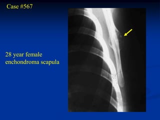 Case #567




28 year female
enchondroma scapula
 