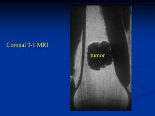 Coronal T-1 MRI
                  tumor
 