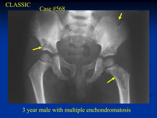 CLASSIC
          Case #568




    3 year male with multiple enchondromatosis
 