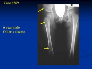 Case #569




6 year male
Ollier’s disease
 