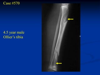 Case #570




4.5 year male
Ollier’s tibia
 