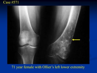 Case #571




    71 year female with Ollier’s left lower extremity
 