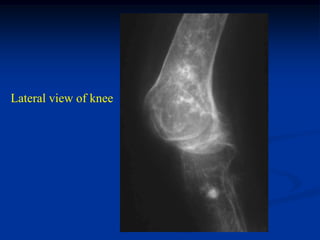 Lateral view of knee
 