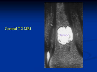 Coronal T-2 MRI
                  tumor
 
