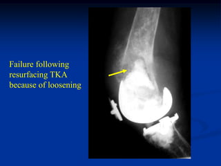Failure following
resurfacing TKA
because of loosening
 