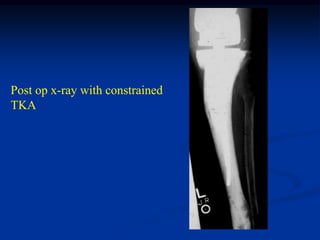 Post op x-ray with constrained
TKA
 