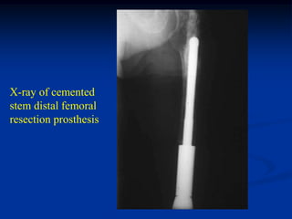 X-ray of cemented
stem distal femoral
resection prosthesis
 