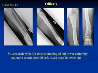 Case #571.1                    Ollier’s




   34 year male with life time shortening of left lower extremity
     and more recent onset of soft tissue mass in lower leg
 