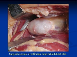Surgical exposure of soft tissue lump behind distal tibia
 