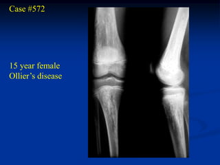 Case #572




15 year female
Ollier’s disease
 