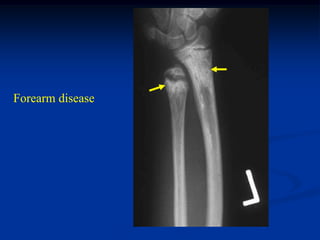 Forearm disease
 