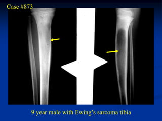 Case #873




        9 year male with Ewing’s sarcoma tibia
 