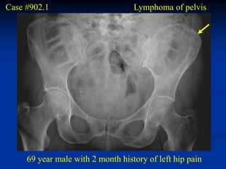 Case #902.1                        Lymphoma of pelvis




     69 year male with 2 month history of left hip pain
 