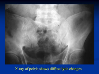 X-ray of pelvis shows diffuse lytic changes
 