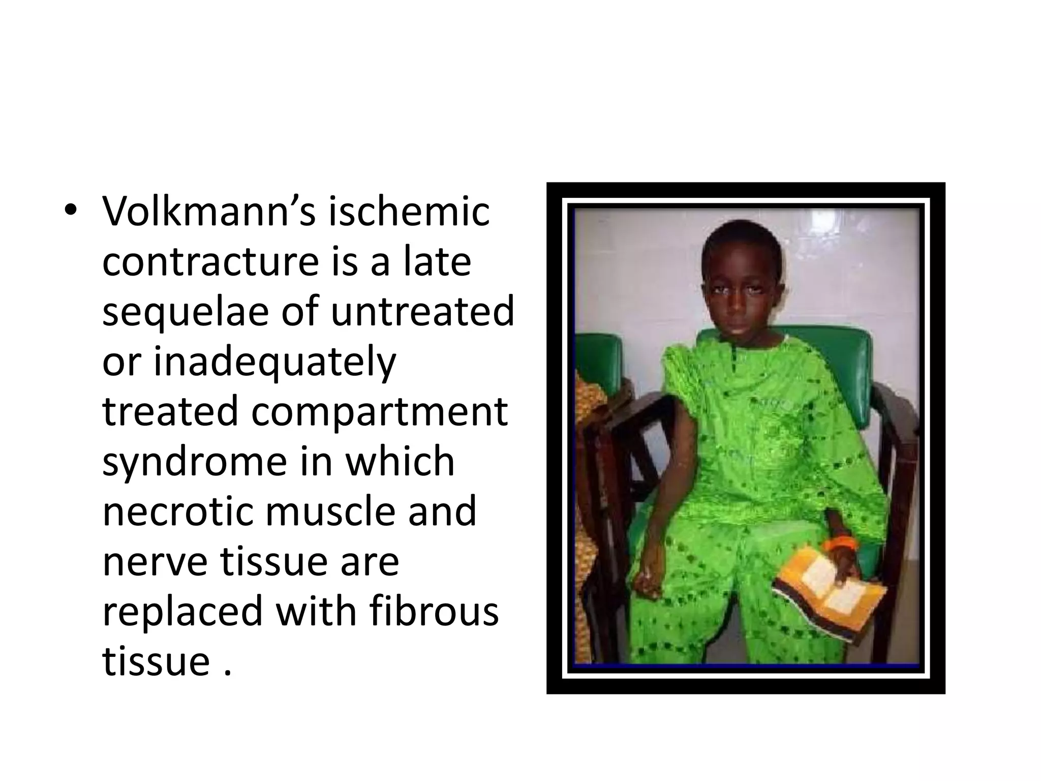 volkmann-s-ischemic-contracture-pptx