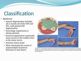Update Volkmann’s Ischemic Contracture.pptx