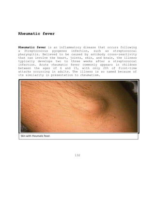 Rheumatic fever
Rheumatic fever is an inflammatory disease that occurs following
a Streptococcus pyogenes infection, such as streptococcal
pharyngitis. Believed to be caused by antibody cross-reactivity
that can involve the heart, joints, skin, and brain, the illness
typically develops two to three weeks after a streptococcal
infection. Acute rheumatic fever commonly appears in children
between the ages of 6 and 15, with only 20% of first-time
attacks occurring in adults. The illness is so named because of
its similarity in presentation to rheumatism.
132
Skin with rheumatic fever.
 