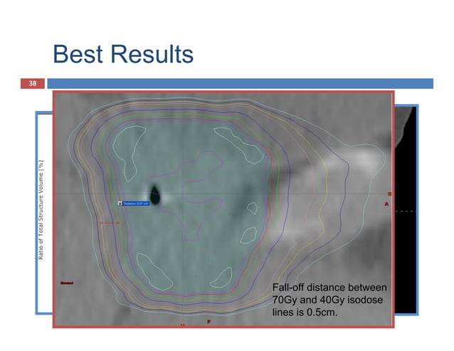 Volumetric Modulated Arc Therapy | PDF | Physics | Science