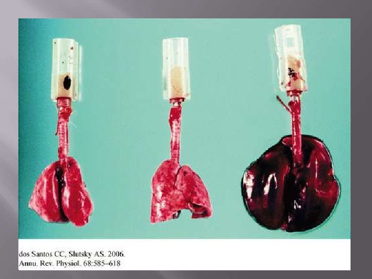 volutrauma vs barotrauma volutrauma vs barotrauma