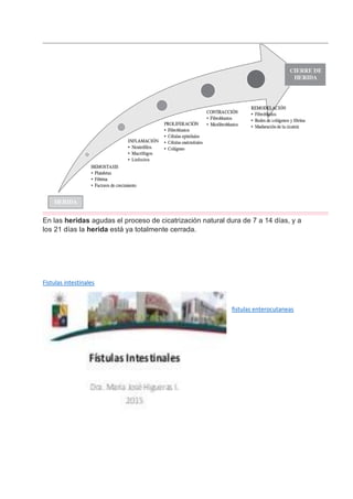En las heridas agudas el proceso de cicatrización natural dura de 7 a 14 días, y a
los 21 días la herida está ya totalmente cerrada.
Fístulas intestinales
fistulas enterocutaneas
 