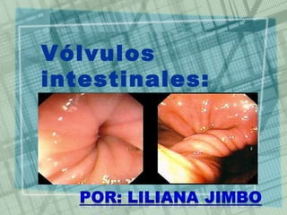 Vólvulos
intestinales:
 