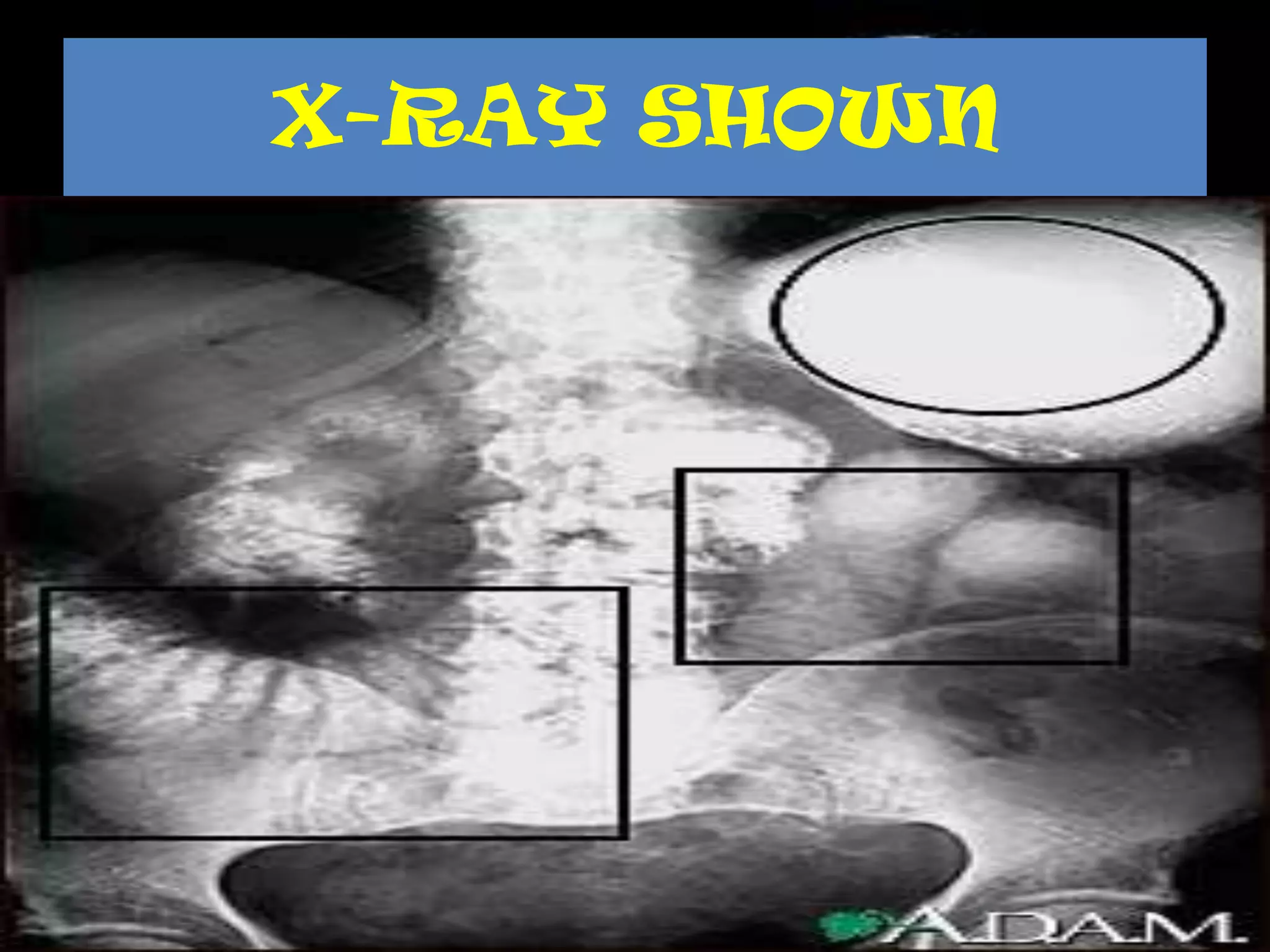 X-RAY SHOWN
 