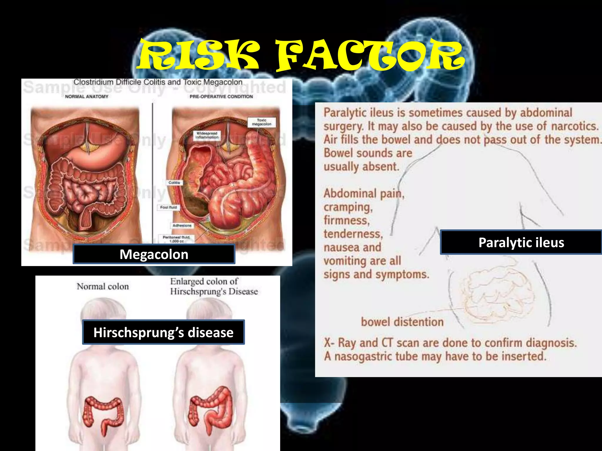 RISK FACTOR



                         Paralytic ileus
    Megacolon




Hirschsprung’s disease
 
