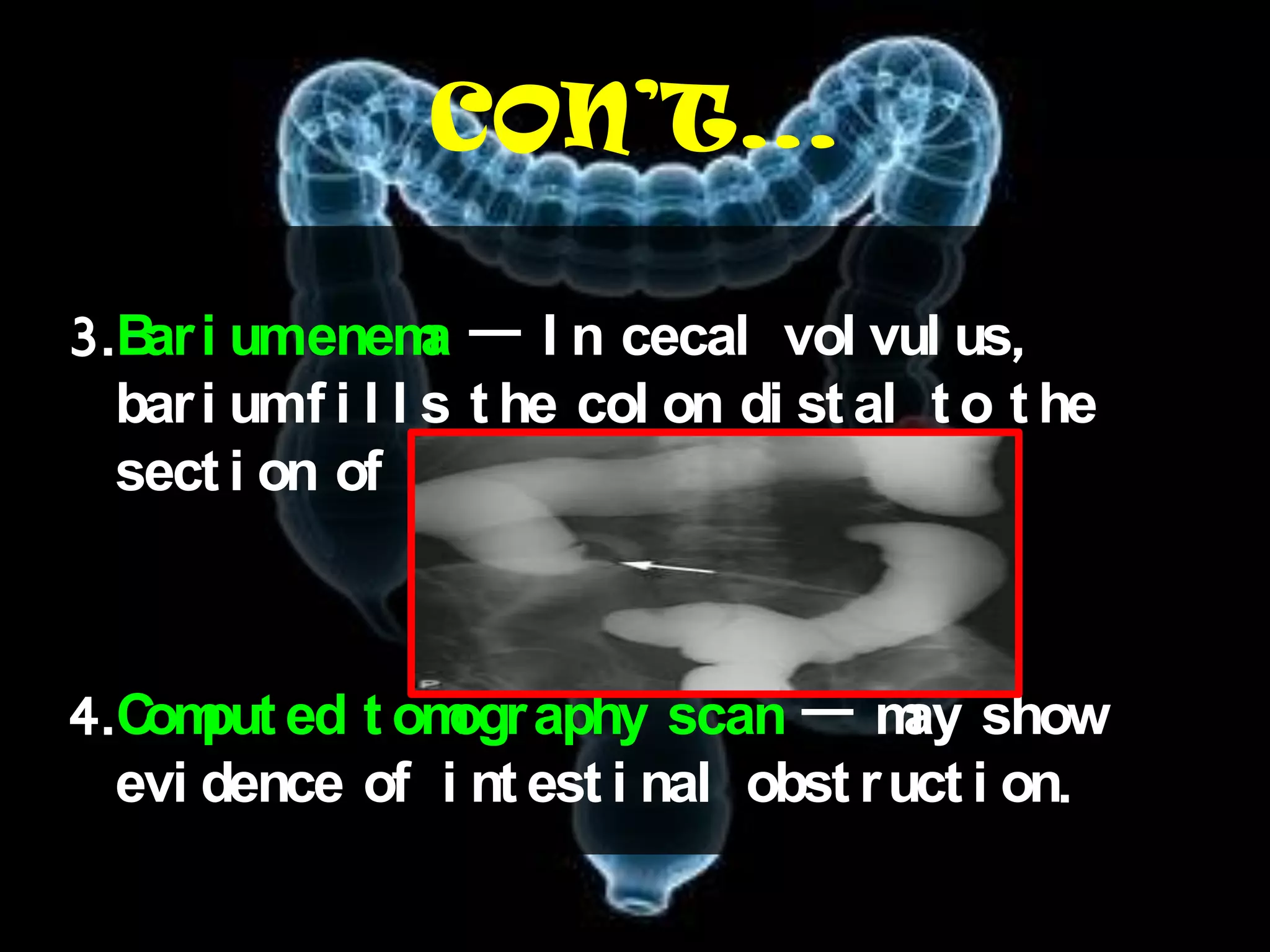 CON’T…

3.B i umenem — I n cecal vol vul us,
   ar             a
  bar i umf i l l s t he col on di st al t o t he
  sect i on of cecum    .



4.C put ed t om aphy scan — m show
   om          ogr                    ay
  evi dence of i nt est i nal obst r uct i on.
 