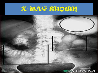X-RAY SHOWN
 