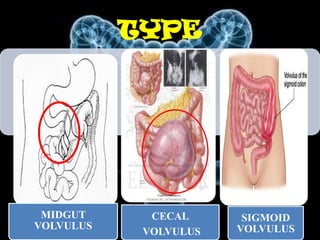 TYPE




 MIDGUT      CECAL      SIGMOID
VOLVULUS               VOLVULUS
            VOLVULUS
 