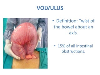 VOLVULUS
• Definition: Twist of
the bowel about an
axis.
• 15% of all intestinal
obstructions.
 
