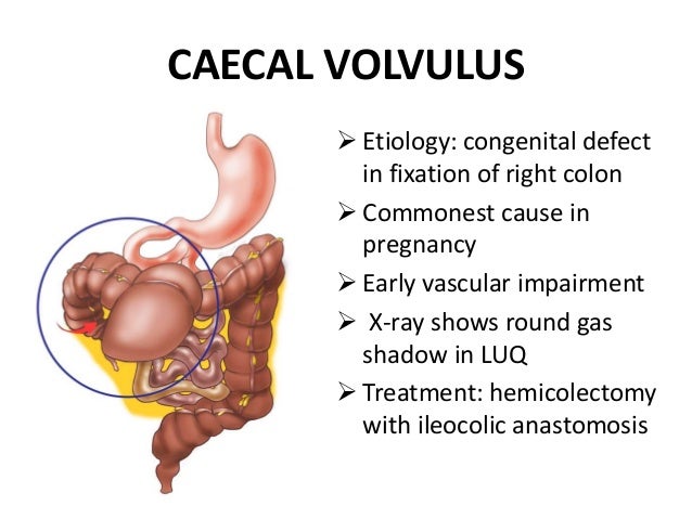 Volvulus diagram of cecal volvulus 