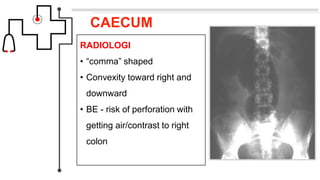 CAECUM
RADIOLOGI
• “comma” shaped
• Convexity toward right and
downward
• BE - risk of perforation with
getting air/contrast to right
colon
 