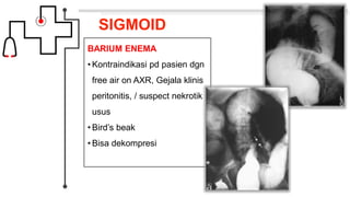 SIGMOID
BARIUM ENEMA
• Kontraindikasi pd pasien dgn
free air on AXR, Gejala klinis
peritonitis, / suspect nekrotik
usus
• Bird’s beak
• Bisa dekompresi
 