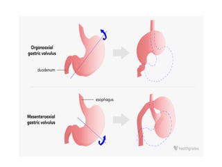 Volvulus Formation surgical condition VOLVULUS made easy for nursing and midwifery ...