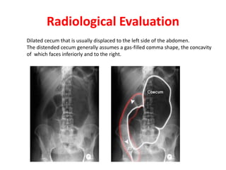 Volvulus Cec Rx Volvulus of colon | PPTX
