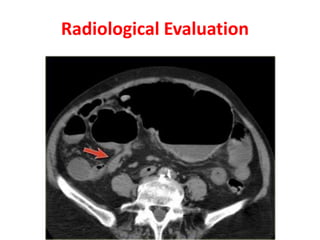 Volvulus of colon | PPTX