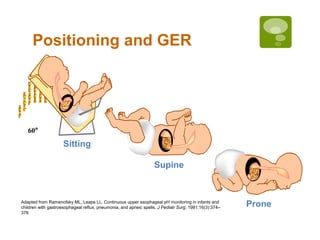 Positioning and GER
Sitting
Supine
Prone
60°
Adapted from Ramenofsky ML, Leape LL. Continuous upper esophageal pH monitoring in infants and
children with gastroesophageal reflux, pneumonia, and apneic spells. J Pediatr Surg. 1981;16(3):374–
378
 