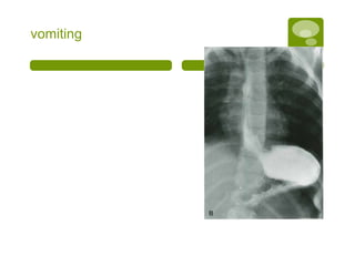 vomiting
 