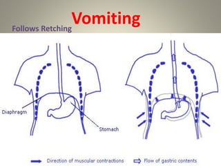 VomitingFollows Retching
 