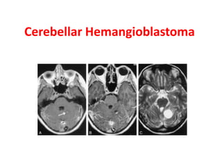 Cerebellar Hemangioblastoma 
 
