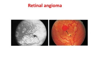 Retinal angioma 
 