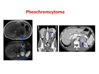 Pheochromcytoma 
 