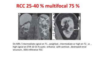 RCC 25-40 % multifocal 75 % 
On MRI / intermediate signal on T1 , weighted , intermediate or high on T2 , w , 
high signal on STIR 10-15 % cystic enhance with contrast , destroyed renal 
structure , DDX infiltrative TCC 
 